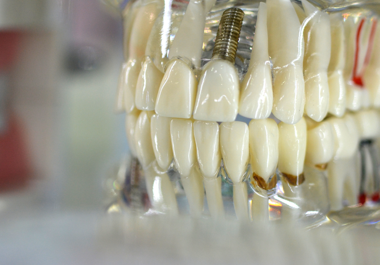 Are Dental Implants the Right Choice for You?
