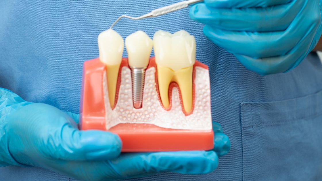 Dental Implants in Parma, Ohio: What You Actually Need to Know