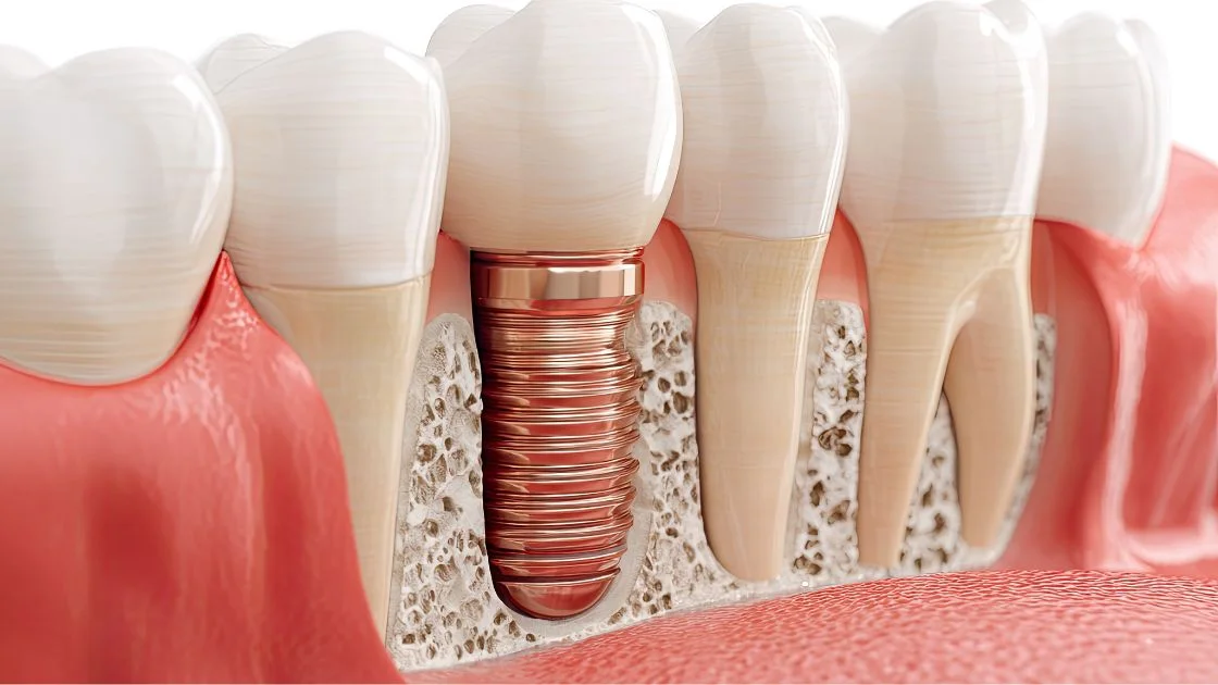 Dental Implants in Parma: What You Need to Know