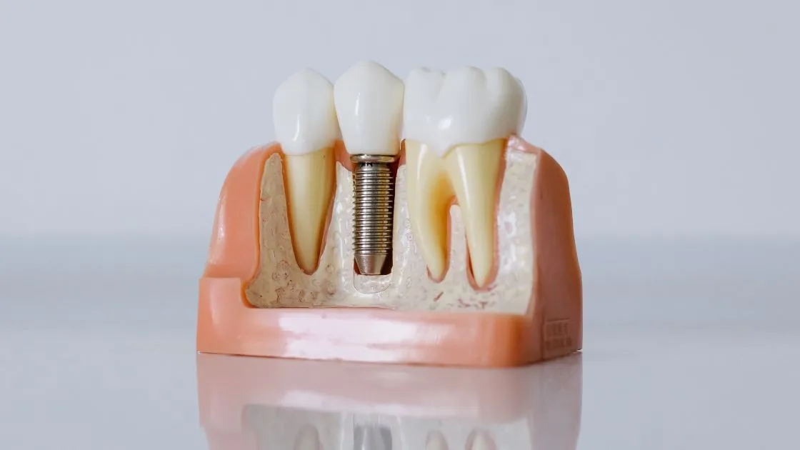 Are Dental Implants Right for You? A Guide for Parma Patients