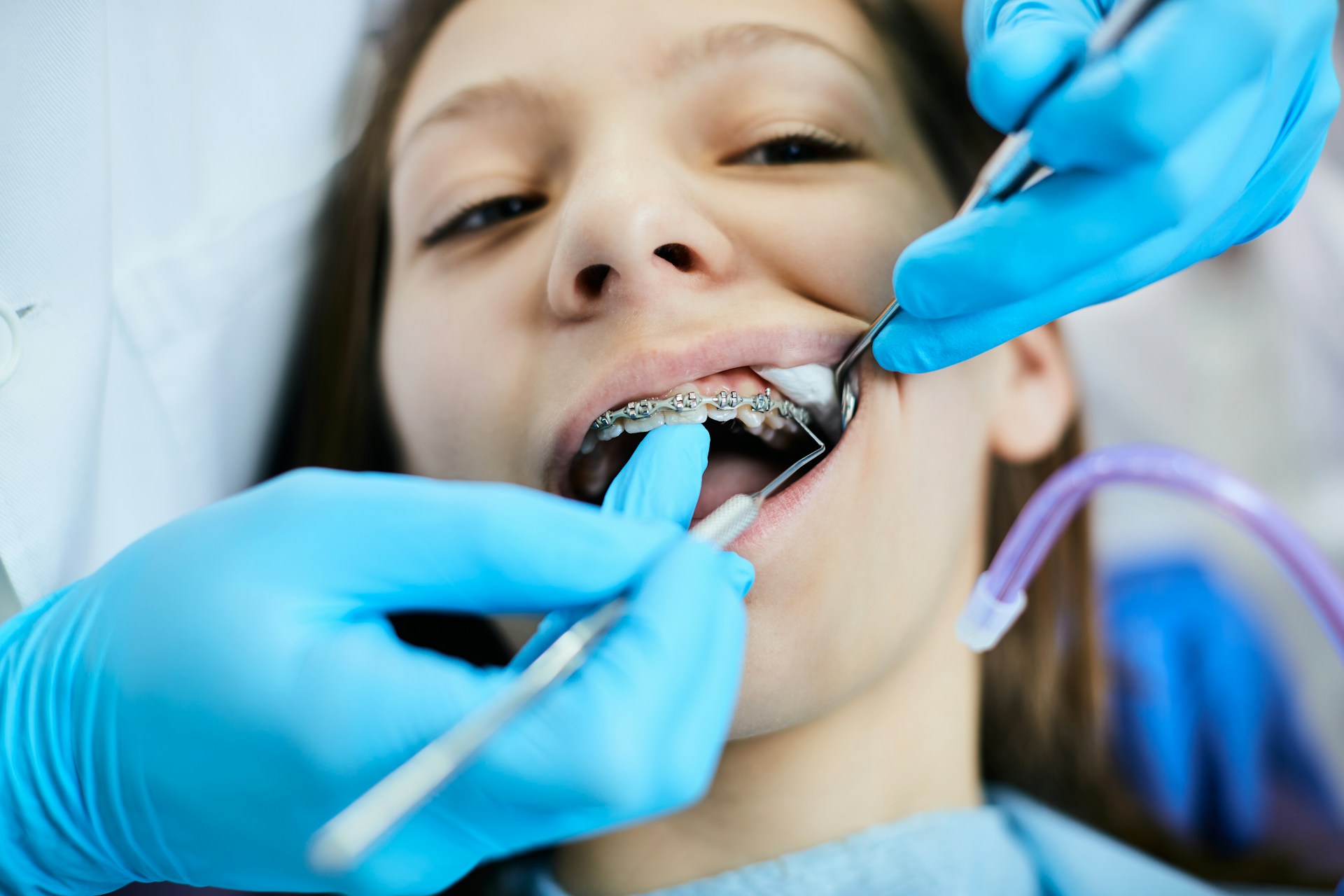 Benefits of Transparent Dental Braces Over Traditional Ones