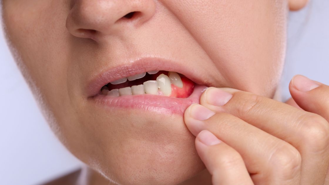 Why See a Periodontal Dentist for Bleeding Gums