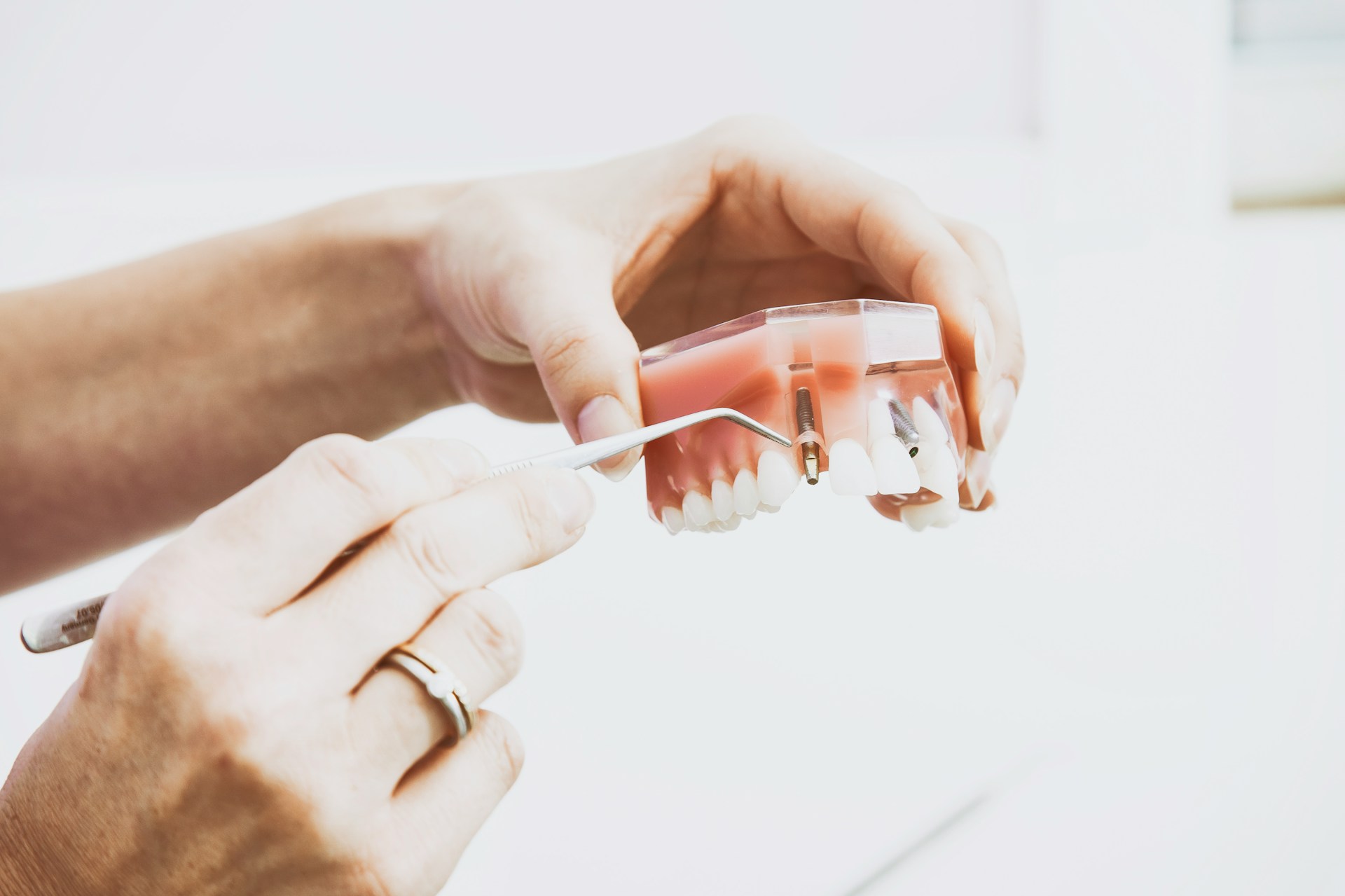 Revolutionizing Your Smile with the Help of Dental Implants