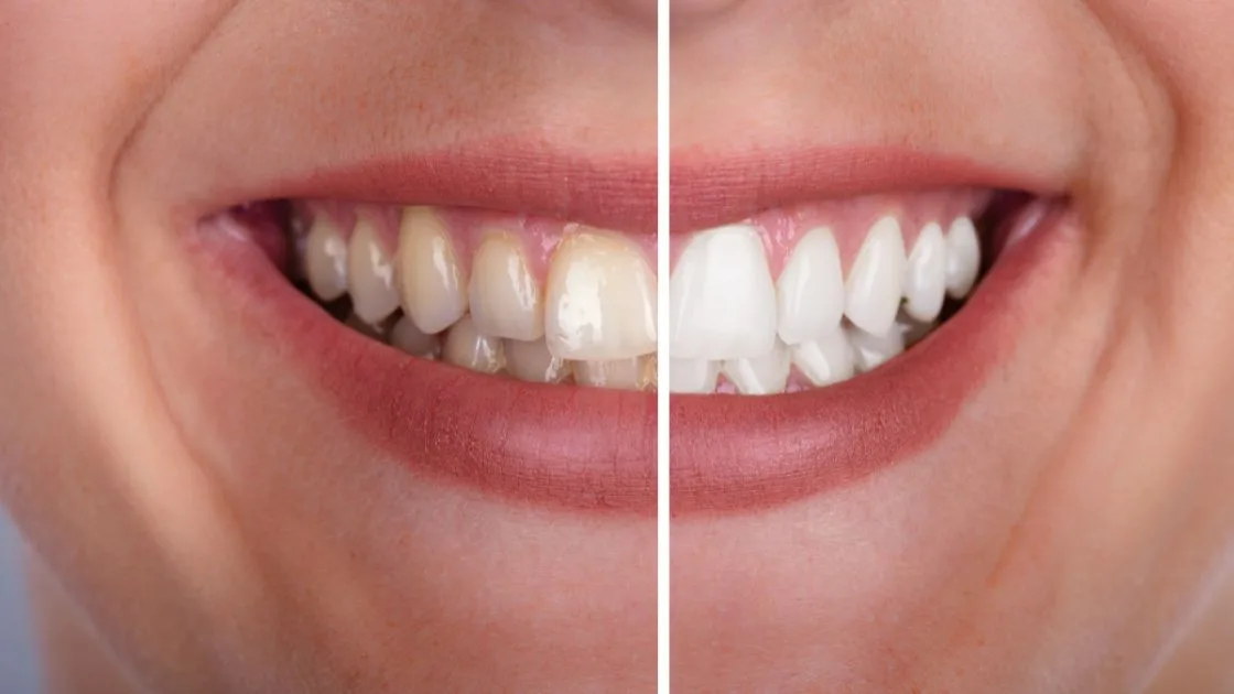 Teeth Whitening in Parma: What You Need to Know