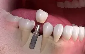 Dental Implants Provider services at Jordan M. Job DDS in Parma, Ohio