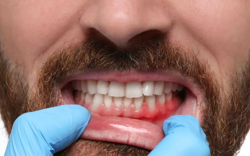 Gingivitis Treatment