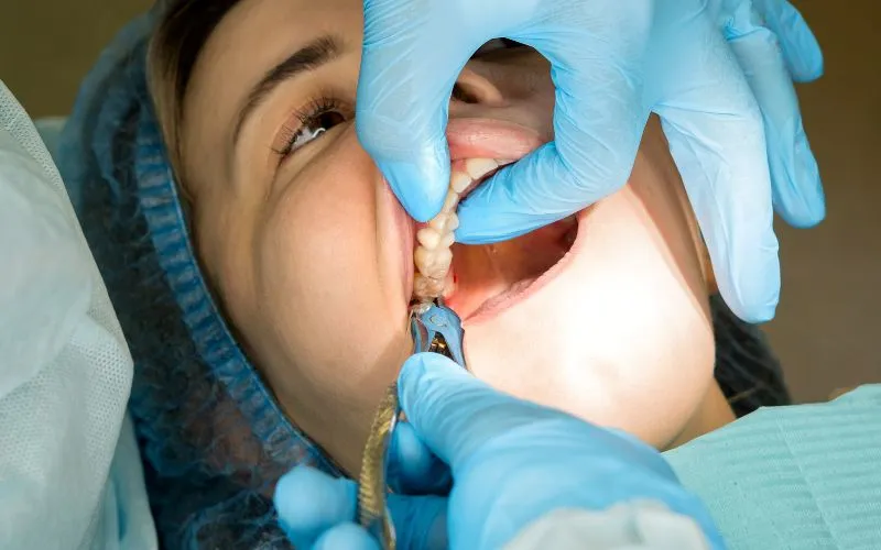 Tooth Extractions