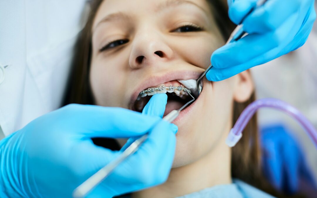 Benefits of Transparent Dental Braces Over Traditional Ones
