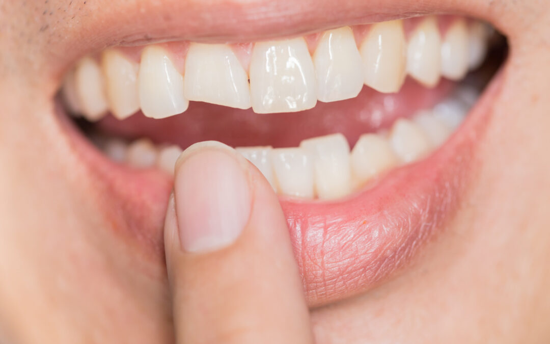 Do Cosmetic Dentistry Services Help If You’ve Chipped a Tooth?