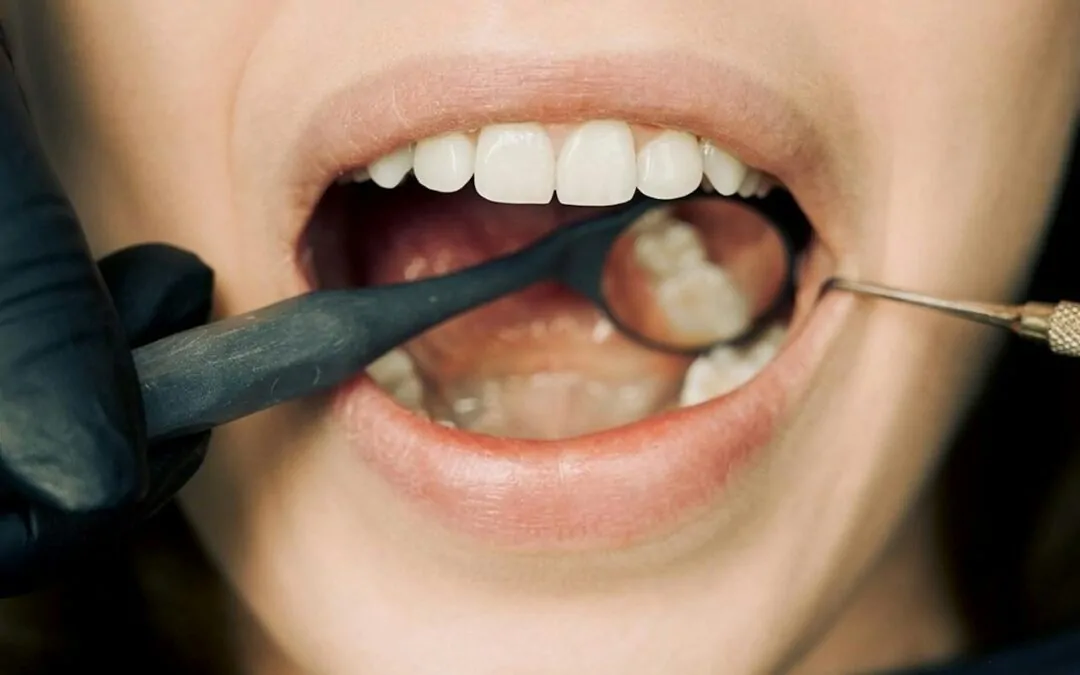 When Should You Consider Getting Dental Bridges?