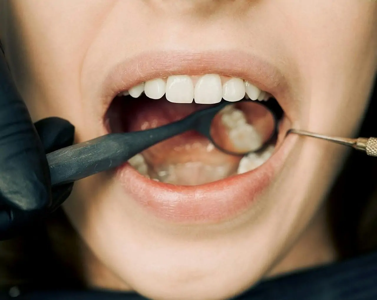 Dental Bridges