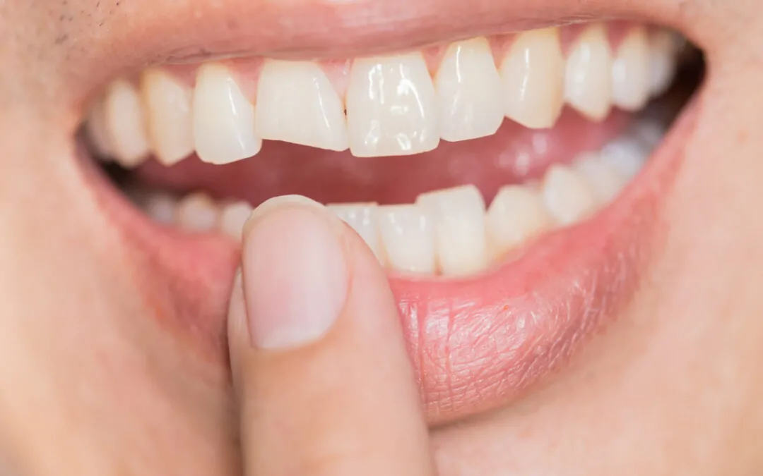 Do Cosmetic Dentistry Services Help If You’ve Chipped a Tooth?